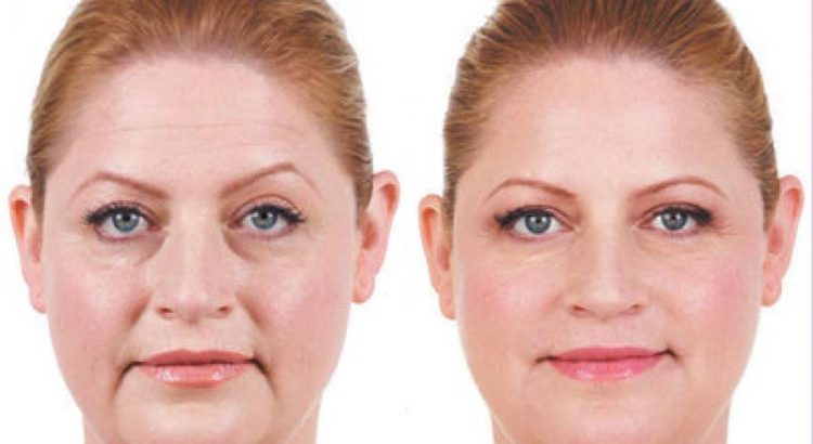Juvederm - Cosmetic Filler