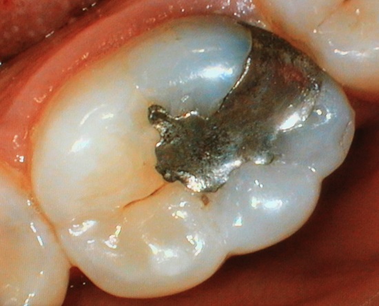 An amalgam filling inside a tooth.