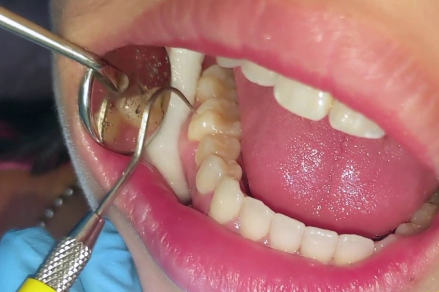 A dentist (face not seen) examines the cavities inside the lower teeth of a patient with a mirror.