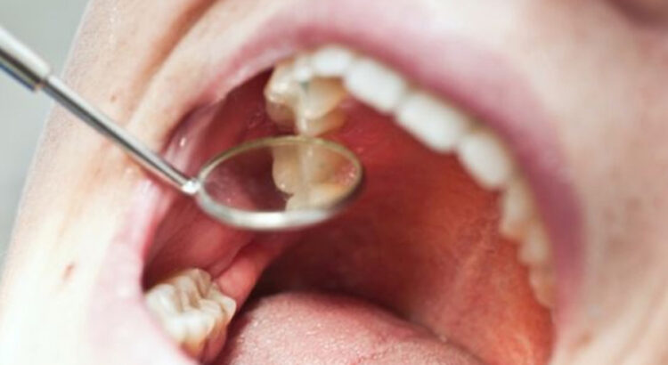 A dentist (face not seen) uses a mirror to examine the cavities in a patient's mouth.