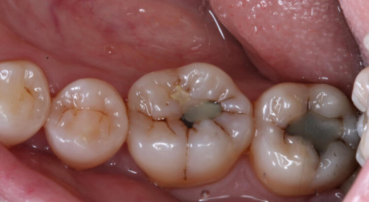 A closeup of cavities in the lower set of teeth in the mouth.