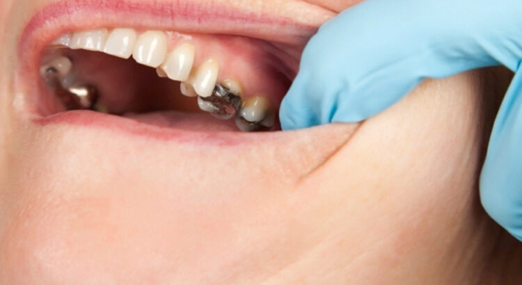 A dentist (face not seen) examining the fillings of a tooth in a patient.